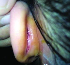 女童走神被老师揪耳朵撕裂2cm